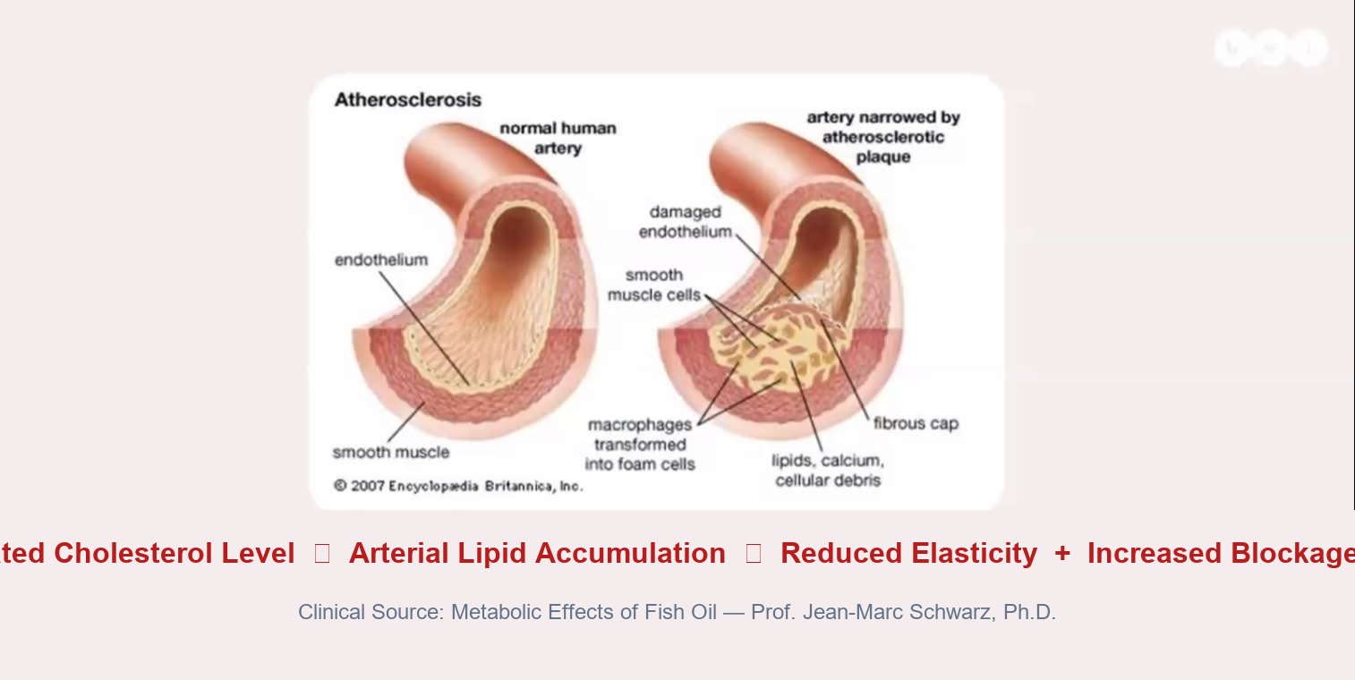 Artery Atherosclerosis Plaque Diagram